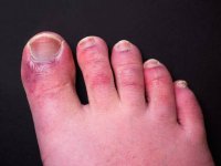 a-mans-toes-showing-what-looks-like-a-rash-with-red-blotchy-skin-a-common-side-effect-of.jpg
